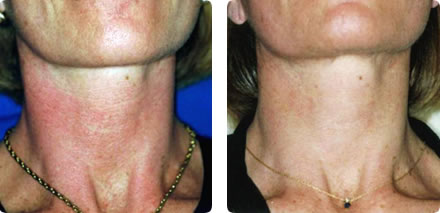 ROSACEA treatent brisbane - Define Laser