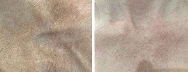Pigmentation Removal Brisbane - Define Laser